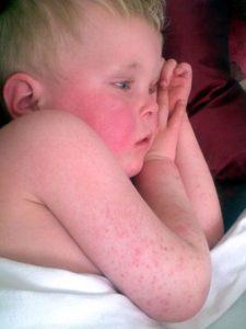 "common types of baby rashes"