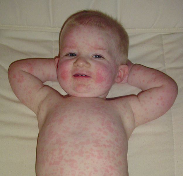 "common types of baby rashes"