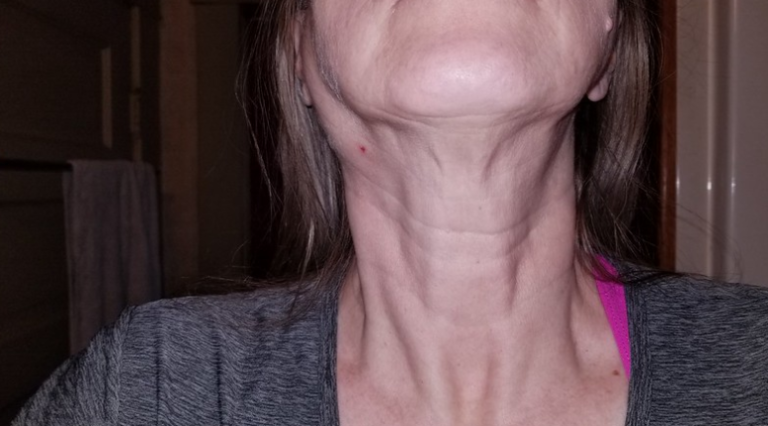 enlarged lymph node in back of neck